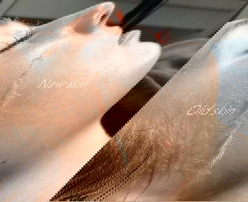 Dermaplaningnewskin