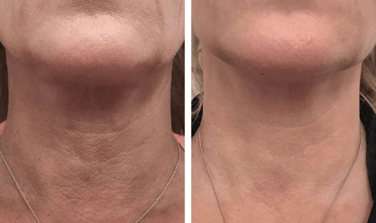 Fillmed at Home of Beauty results