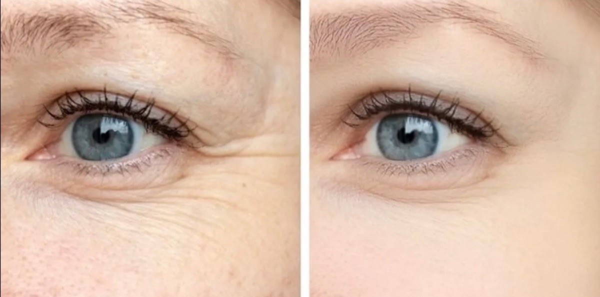 Fillmed eyes before and after at home of beauty