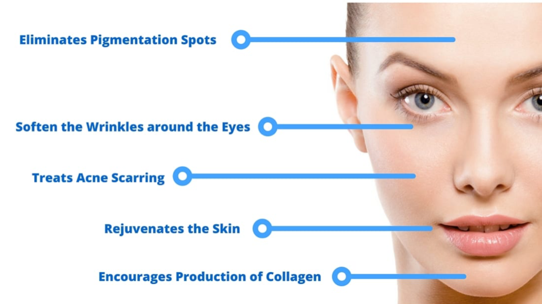 Micro needling June