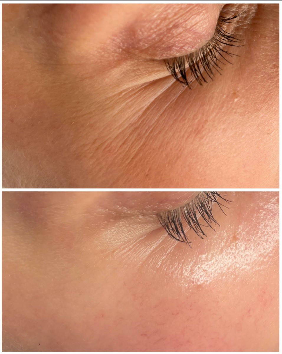 Before and After 2