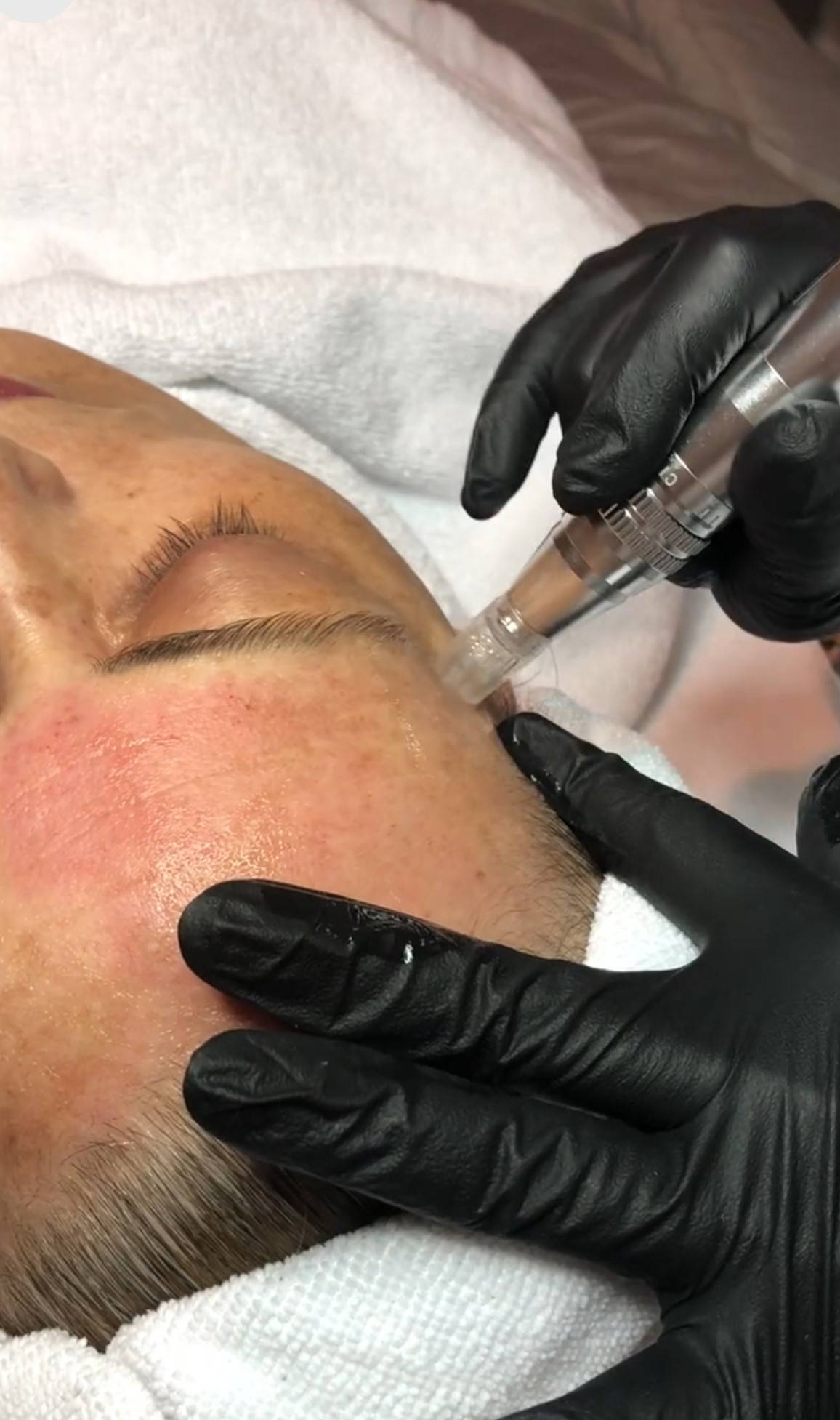 Microneedling