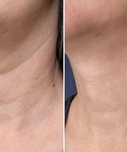 Neck 1