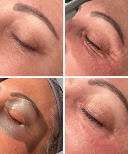 Skin Treatment 1