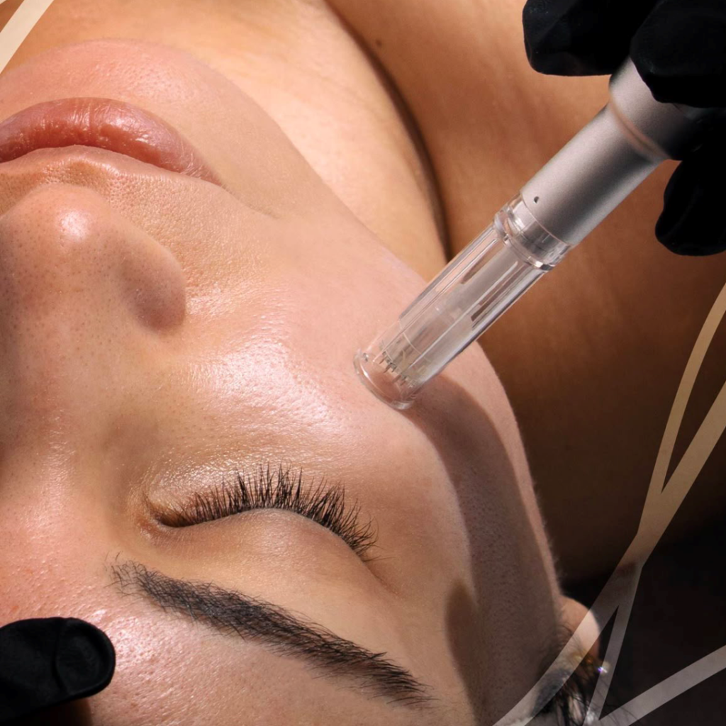 Ultimate MicroNeedling Image 1